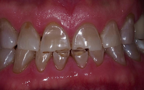 Antes