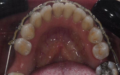 Antes